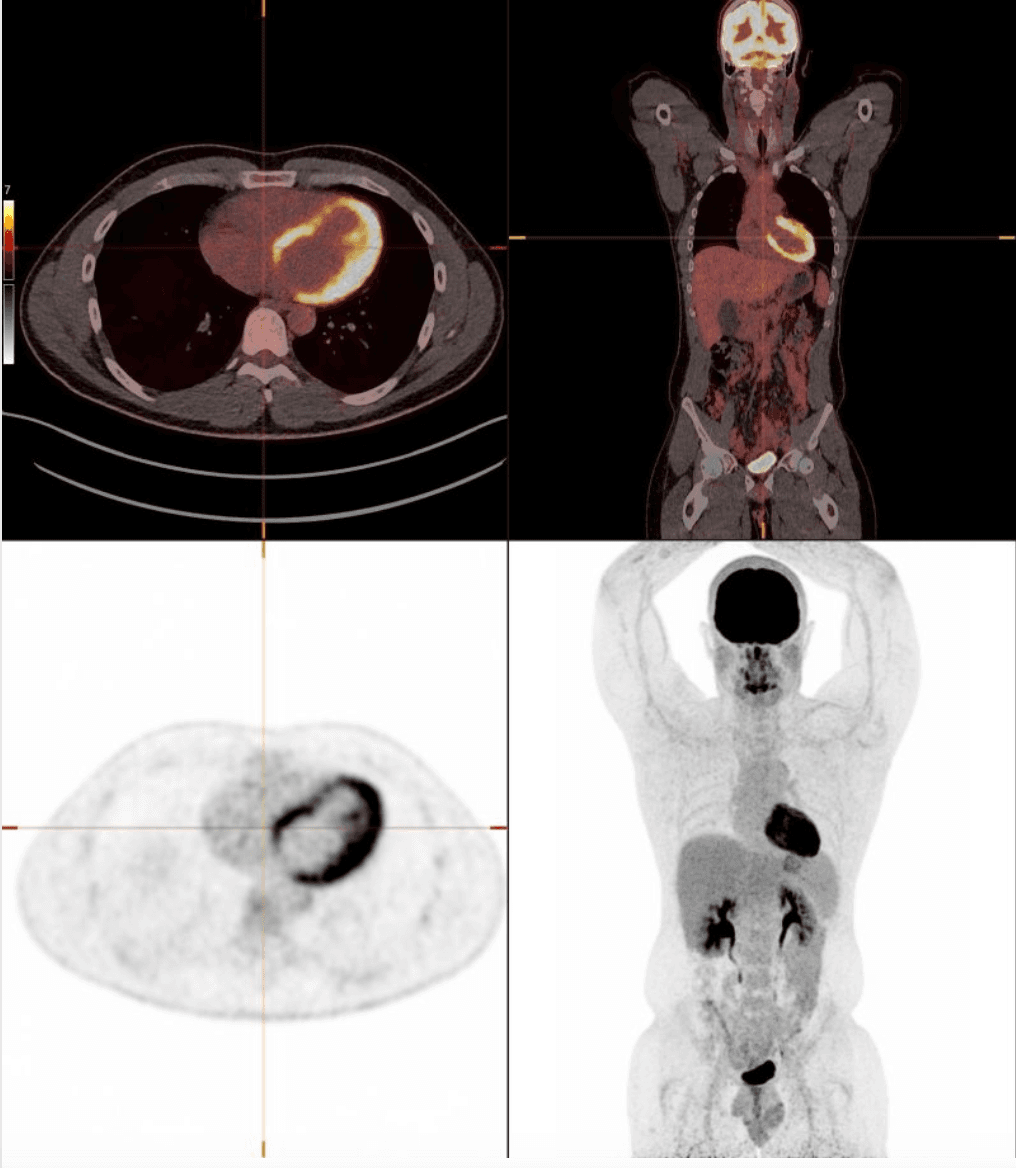 PET-CT - nuclear radiology